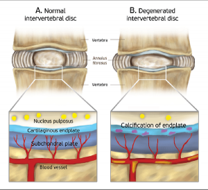 Disc degeneration discogenic pain