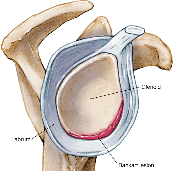 Bankart and Hill-Sachs lesions of the shoulder joint 6 Bankart lesion at the antero-inferior portion of the glenoid