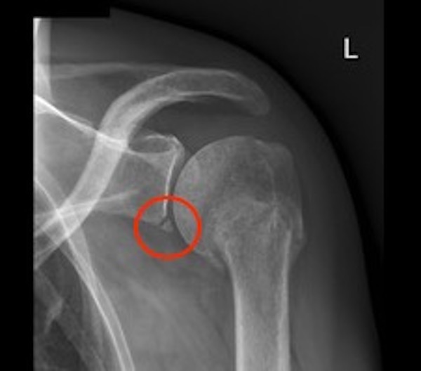 Bankart and Hill-Sachs lesions of the shoulder joint 3 X-ray showing an osseous Bankart lesion at the inferior part of the glenoid fossa