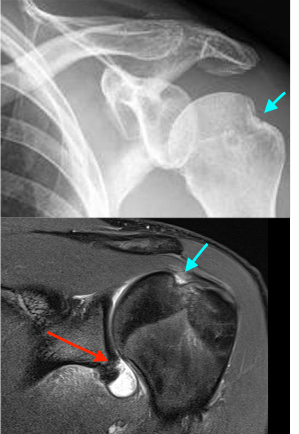 Bankart and Hill-Sachs lesions of the shoulder joint 2 Bankart Lesion at the antero-inferior part of the glenoid labrum (red arrow) and Hill-Sachs lesion of the humeral head (blue arrow) on X-ray image above and MRI scan below.