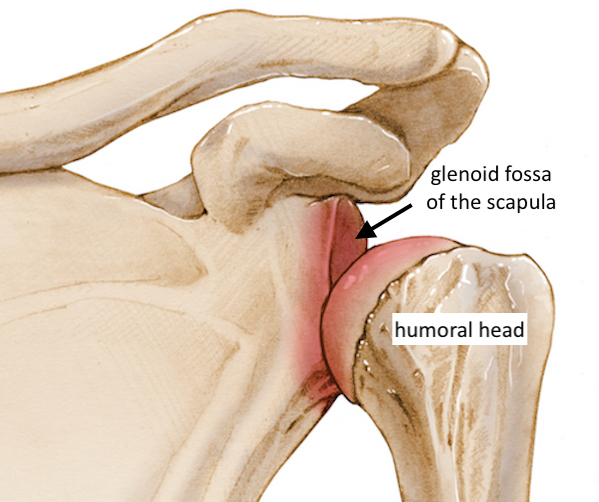 Bankart and Hill-Sachs lesions of the shoulder joint 1 Illustration of an anterior shoulder dislocation whereby the humeral head slips out of the anterior side of the glenoid fossa