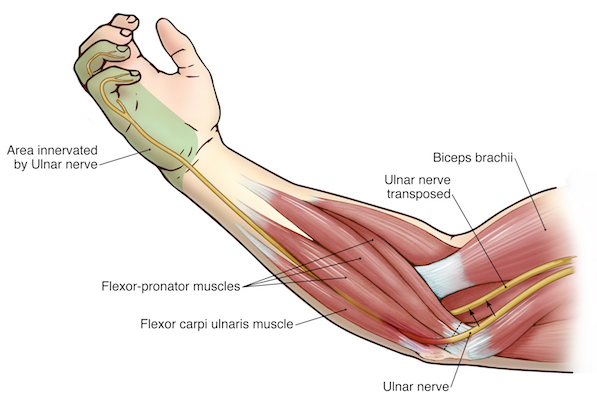 Ulnar nerve entrapment 6 Surgical ulnar nerve transposition. The arrows show the transfer of the ulnar nerve upwards to reduce friction