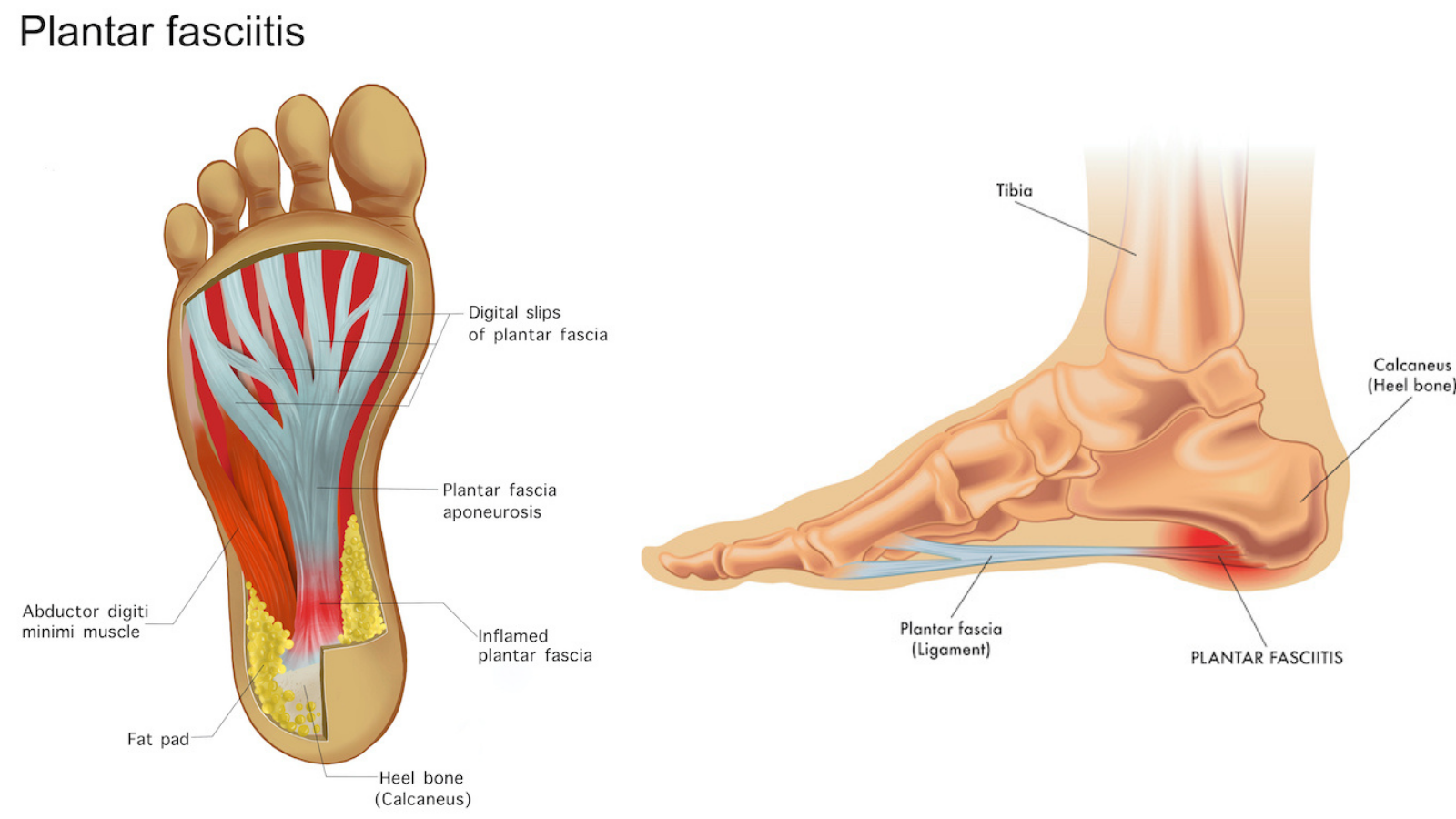 Plantar heel pain and the rise of "Ugg boot foot" 1 1