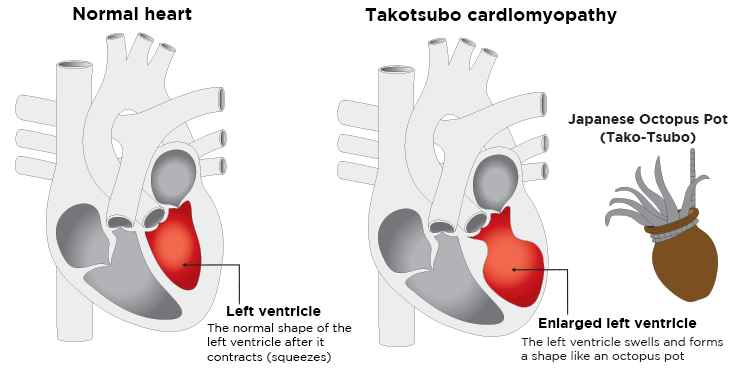 Broken heart syndrome: Drawing of a normal heart (left) and a heart with takotsubo cardiomyopathy (right) showing the abnormal/enlarged shape of the left ventricle resembling a Japanese octopus trap