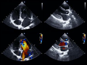 Anatomy of the heart comparing the function of the aortic valve in healthy (left) and stenotic (right) conditions. Note the inability of the lower right valve to fully close due to stenosis.