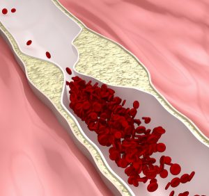 Plaques formed inside the wall of an artery reduce the vessel lumen and restrict the blood flow, facilitating the formation of clots. Both a dislodged plaque and a blood clot can travel to the heart or the brain causing heart infarct and stroke, respectively.