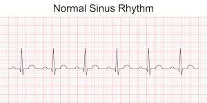 Typical image of an electrocardiogram of a healthy heart.