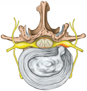 Disc Herniation