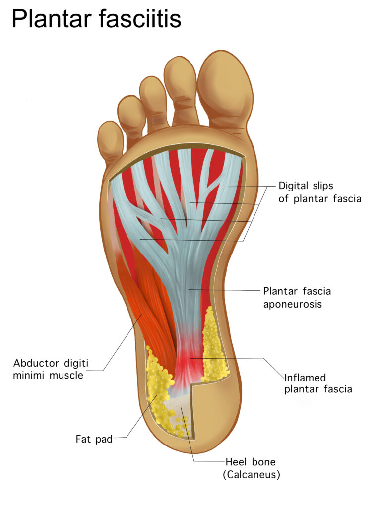 painful,plantar,fasciitis,ligament,feet,disorder,.,study,education,medical